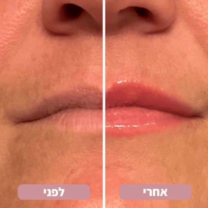 Lip Glow® - מנפח שפתיים ומעשיר בלחות